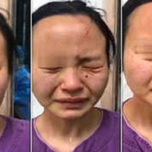 CHINE :  un africain atteint du coronavirus mord sauvagement le nez d’une infirmière chinoise