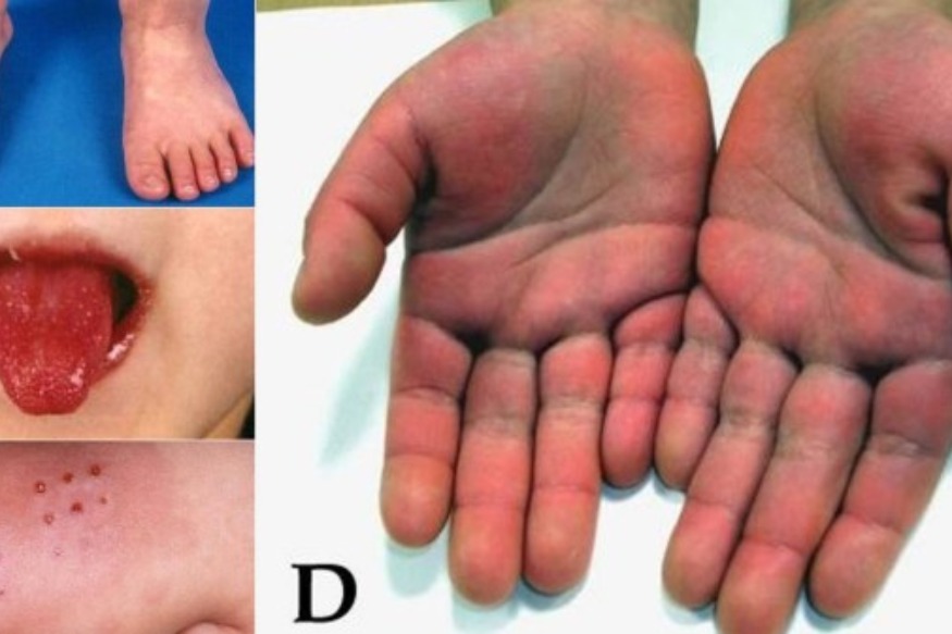 SANTE : Urgent : Kawasaki, un nouveau virus qui tue les enfants plus que le coronavirus